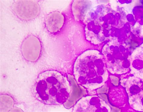 cytology-exam-of-pleural-fluid-708x556-2x