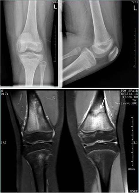 Normal Pediatric Ankle Xray