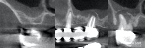 Sinus Perforation After Tooth Extraction Foundation Bone Graft Prf