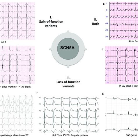 Examples Of Clinical Overlap Due To Pathogenic Variants In The Scn A