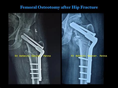 Avascular Necrosis Avn Treatment And Management Dr Ashwini Gaurav