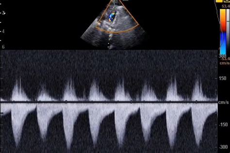 Suprasternal View Of Transthoracic Echocardiography Shows Severe