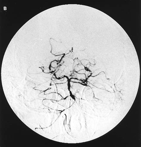 Thrombolytic Therapy Of Acute Basilar Artery Occlusion Stroke