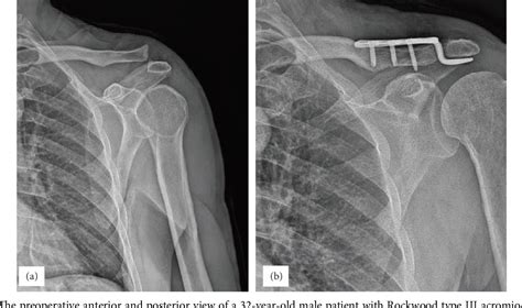 Figure 2 From Comparison Of The Hook Plate Versus Tightrope System In The Treatment Of Acute