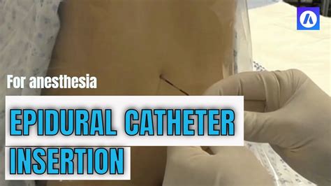 Epidural Catheter Insertion YouTube