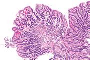 Reactive gastropathy - Libre Pathology