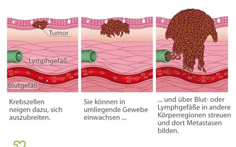 Was Sind Metastasen Onmeda De