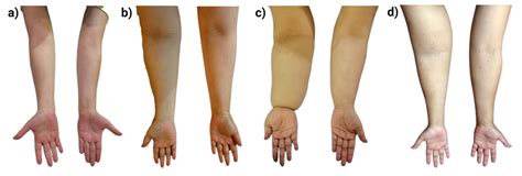 Lymphedema Arm