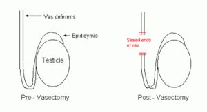 What To Expect After Vasectomy Reversal Procedure - Top Vasectomy ...