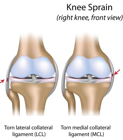 Sprained Knee Heal Fast And Strong Physio Prescription