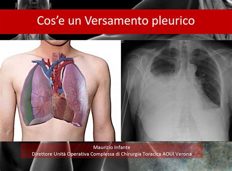 Cos Un Versamento Pleurico Dr Maurizio Infante