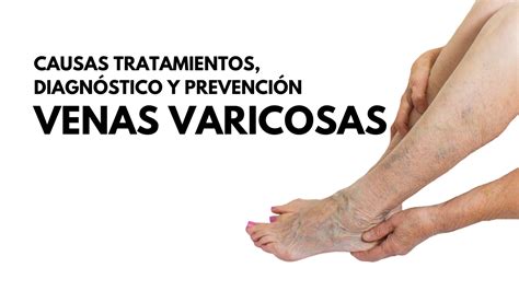 Venas Varicosas Causas Y Consejos Para Evitarlas Hot Sex Picture