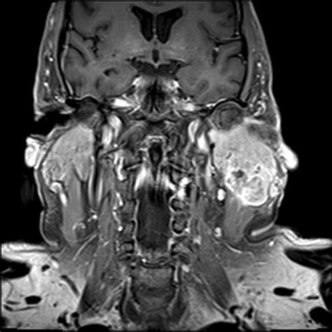 MRI shows a lobular, enhancing infiltrative mass in the left parotid ...