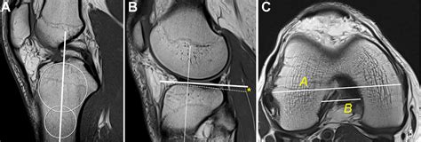 Bone Morphological Characteristics As Risk Factors For Anterior