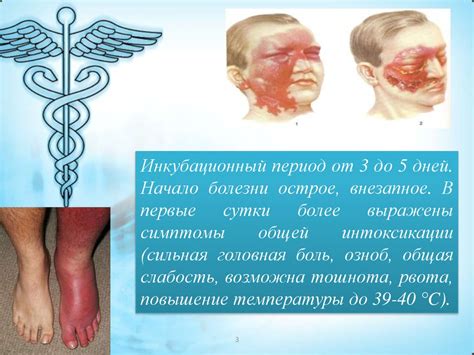 Рожистое воспаление - презентация онлайн