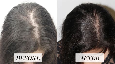 Platelet Rich Plasma Treatment for Hair Loss: Here's What to Know | Allure