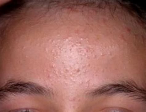 Pimple Like Bumps On Scalp