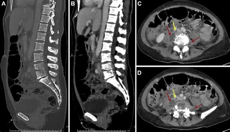 E Sagittal Ct Images From Abdominal Pelvis Ct In Bone A And Download Scientific Diagram