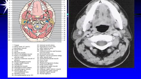 Ct Mri Larynx Pharynx Anatomy Youtube