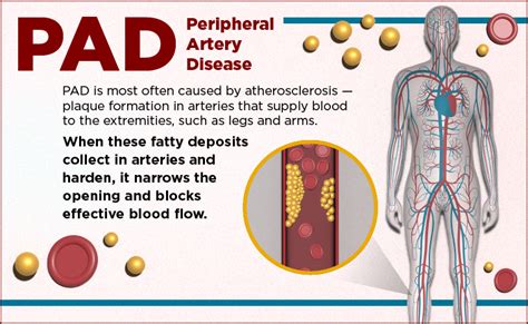 What You Need To Know About Peripheral Artery Disease UChicago Medicine