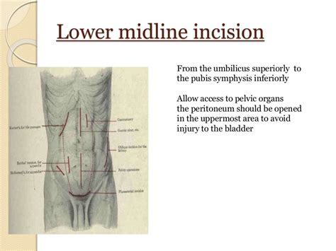 Abdominal Incisions