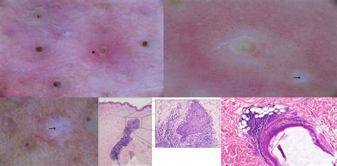 A C Dermoscopy Of Folliculotropic Mycosis Fungoides Comedo Like