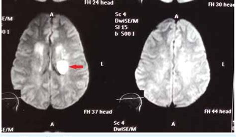 [PDF] Tongue Deviation in Acute Ischemic Stroke. | Semantic Scholar