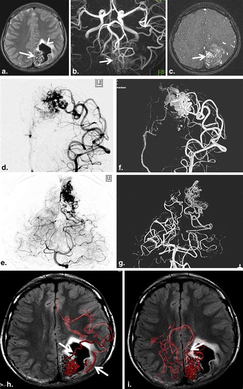 Usefulness Of 3D DSA MR Fusion Imaging In The Pretreatment Evaluation