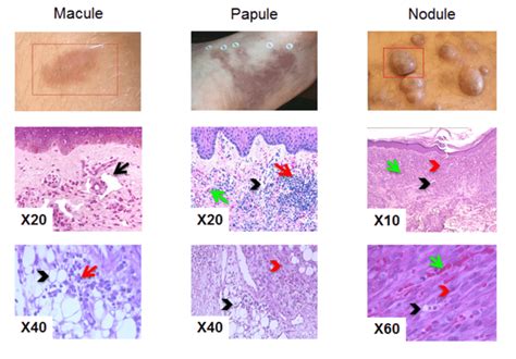 Présentation Histologique Des Lésions De Mk Macule Présence