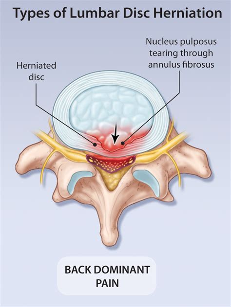 Current Management of Symptomatic Lumbar Disc Herniation | HealthPlexus.net