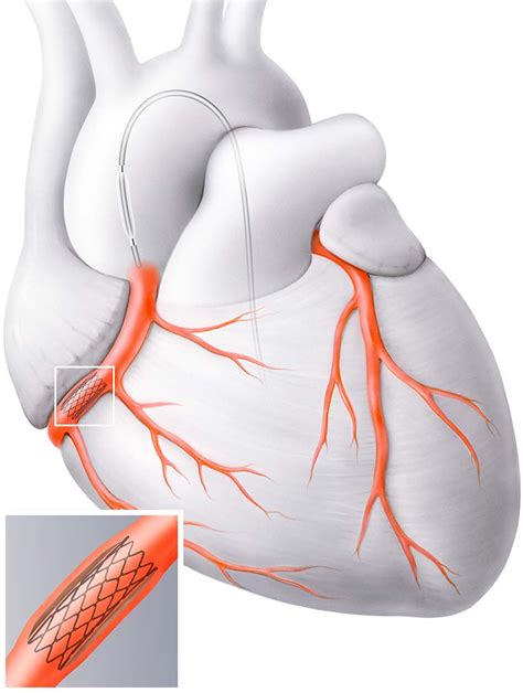 Stent Implantation PCI Bei Koronarplaques