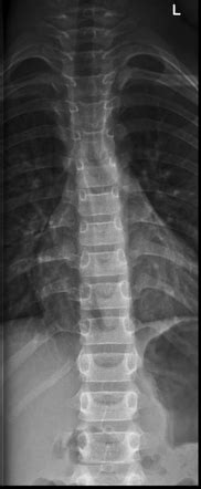 Normal Paediatric Thoracic Spine Series Radiology Case Radiopaedia Org