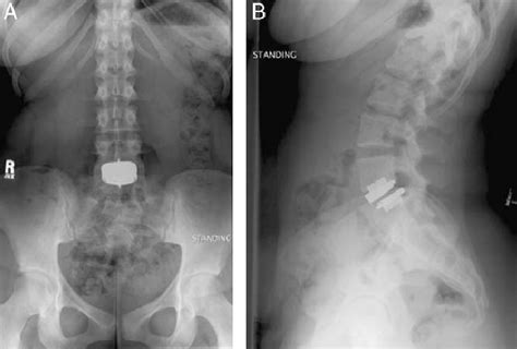 Standing Anterio Posterior A And Lateral B Radiographs 11 Months