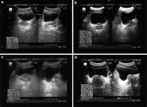 Of Prostate Ultrasound For Benign Prostatic Hyperplasia And Male Urinary Stress Incontinence