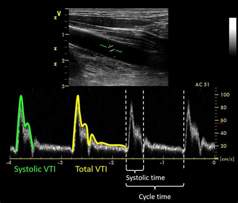 Doppler Ultrasonography Of The Left Common Carotid Artery Red Line Download Scientific Diagram