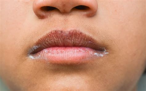 Cracked Lip Corners The Strange Reason