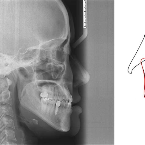 A Typical Case Of Class III Malocclusion Treatment Using Total