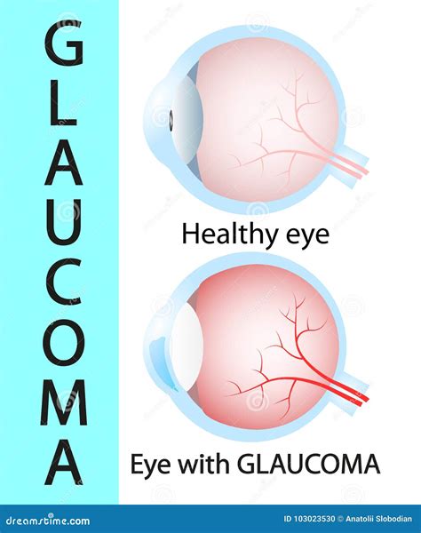 Glaucoma Y Estructura Detallada Del Ojo Sano Ilustración Del Vector