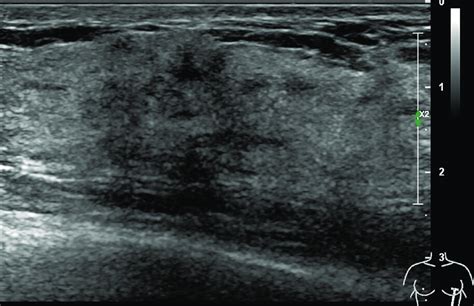 32-year-old with a non-mass lesion in the right breast. Image shows the... | Download Scientific ...