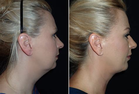 Submentoplasty Richmond Va Chin And Neck Lift Neck Rejuvenation