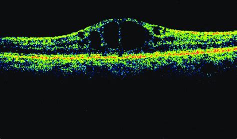 Optical Coherence Tomography Showing Cystoid Macular Edema In Download Scientific Diagram