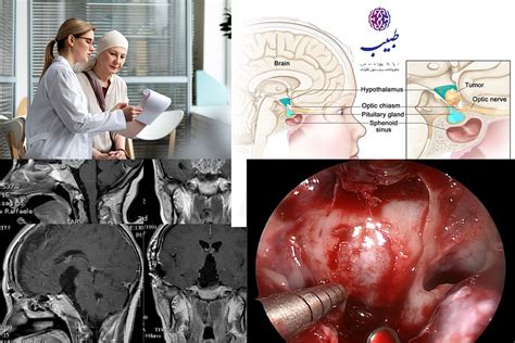 تومور مغزی کرانیوفارنژیوما چیست ؟ کلینیک طبیب مرکز فوق تخصصی مغز و