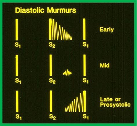 Diagnosis Of Cardiac Murmurs In Children