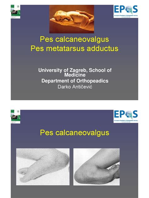 6. Pes Calcaneovalgus Anticevic 18.05.2011 | Foot | Diseases And Disorders