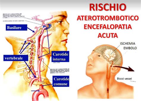 Cura Dell Ictus Ischemico