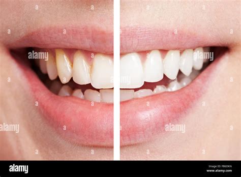 Comparison Of Teeth Before And After Bleaching Session Stock Photo Alamy