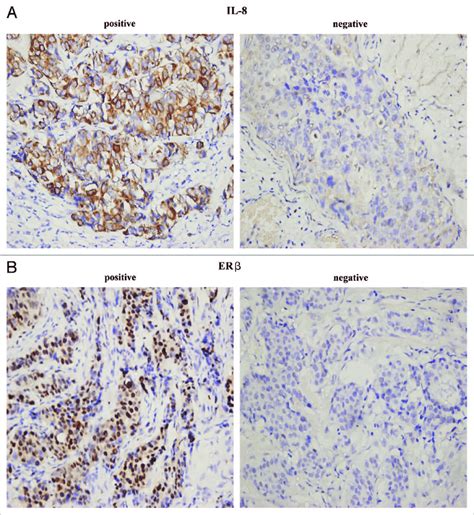 Expression Of Er And Il In Representative Human Primary Breast Tumor