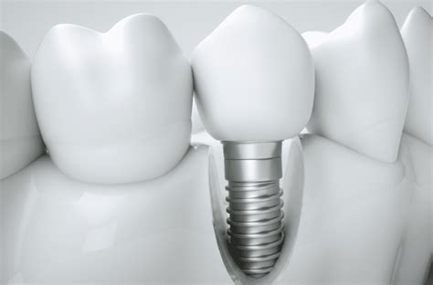 Can Dental Implants Restore Face Shape Dental Implants