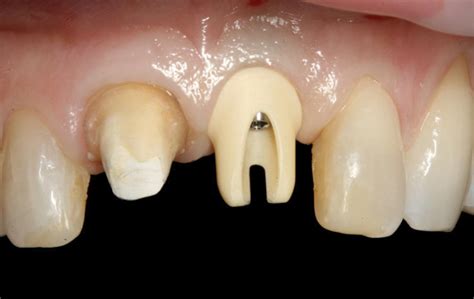 Case Report Using The H” Abutment Achieving Esthetics Strength And