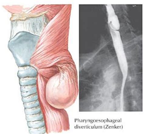 Figure From Surgical Treatment Of Zenkers Diverticulum Is The Open